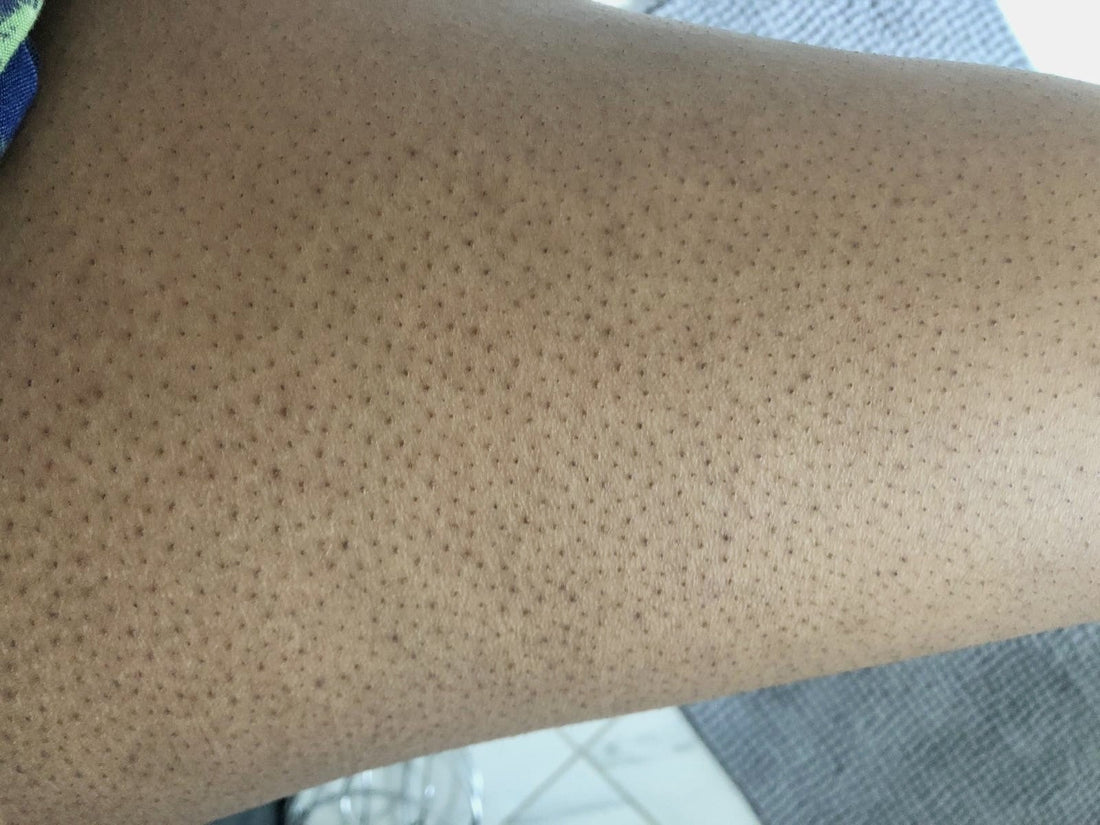 Keratosis Pilaris on Leg